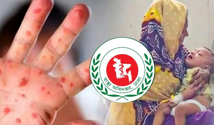 হাম ও সংশ্লিষ্ট উপসর্গে ১০ শিশুর মৃত্যু, শনাক্ত ১,১৬৬ আক্রান্ত
